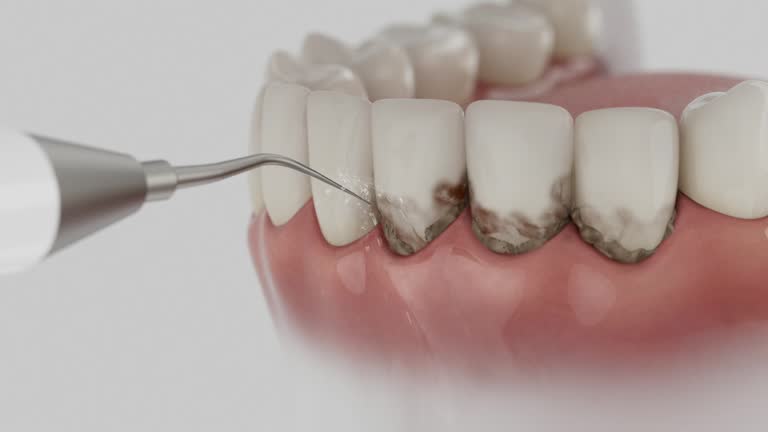 Trusted Wisdom Tooth Removal service in Chapin, SC - Dentist Open Now